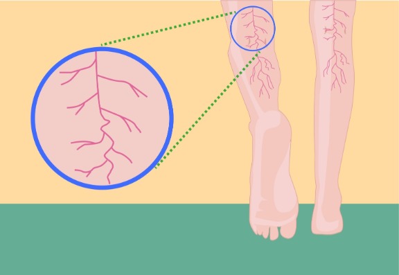 What Are Spider Veins? 