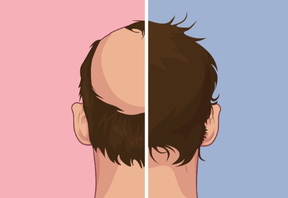 Don't suffer alone with alopecia