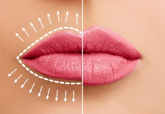 Asymmetry in the lips following lip fillers