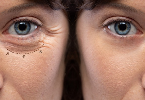 Would You Benefit From Endymed Treatment?