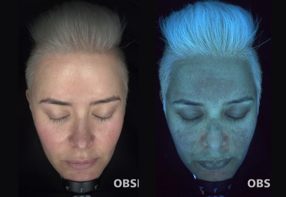 Can pigmentation be treated