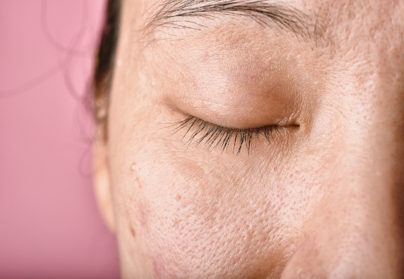 Acne starts with a blocked pore.