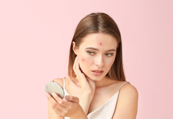 Treatments for acne
