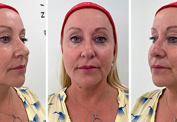Before and After Treatment
