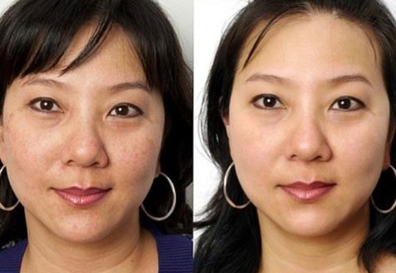 before and after treatment