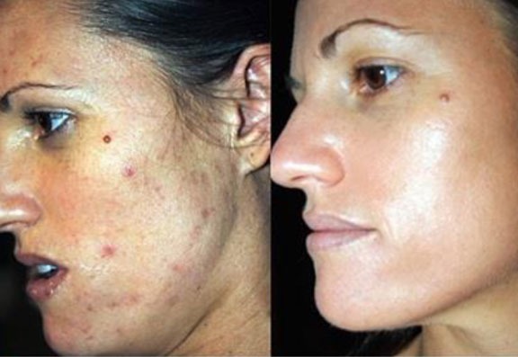 before and after treatment