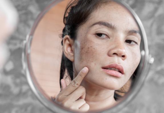 How effective is perfect peel treatment
