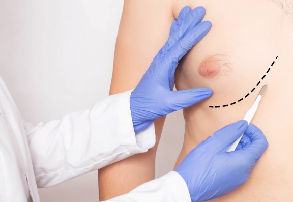 Understanding Gynecomastia