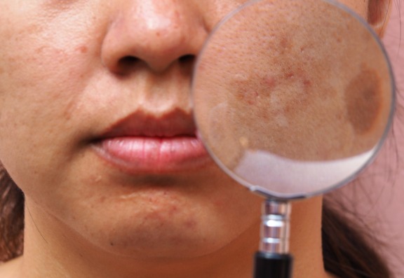 Medical Skin Needling For Asian Skins