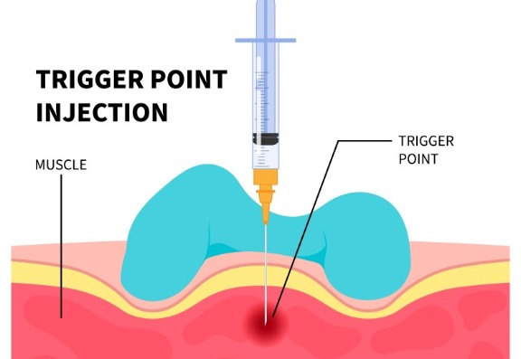 How are the injections administered into the trapezius muscle?