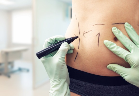 Exploring Body Contouring Treatments