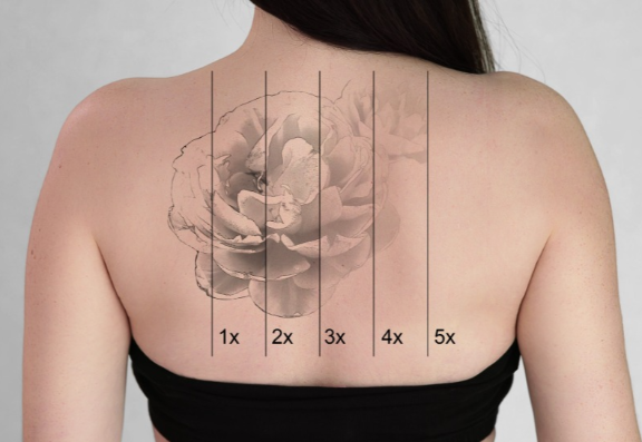 How does laser tattoo removal work?