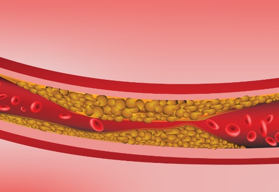 What is a vascular occlusion?