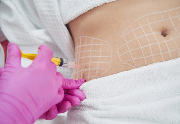 What are the Benefits of Profhilo Body?