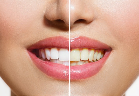 Is there anything I can do at home to help keep my teeth white? 