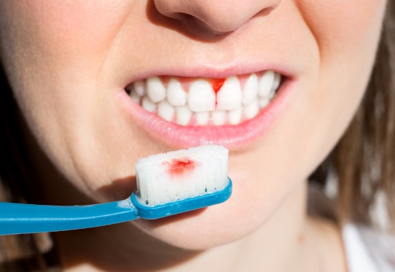 Why do my gums bleed? 