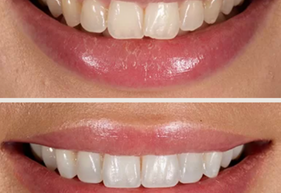 Composite Bonding