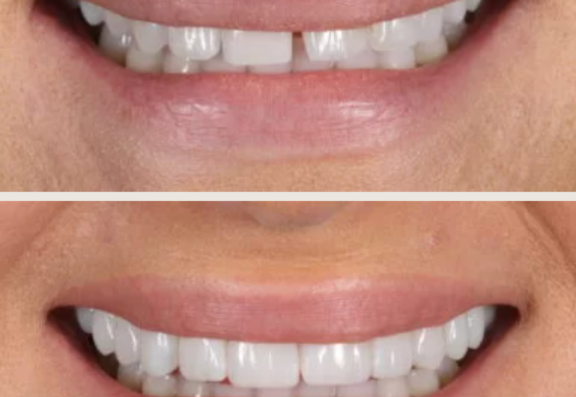 Composite Bonding 