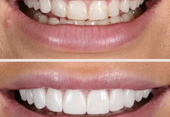 Porcelain Veneers 