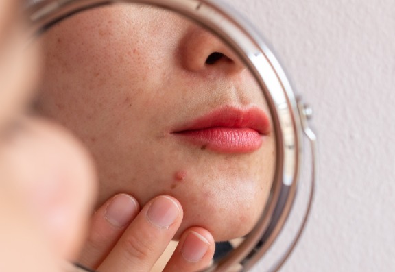 How does stress display on the skin?