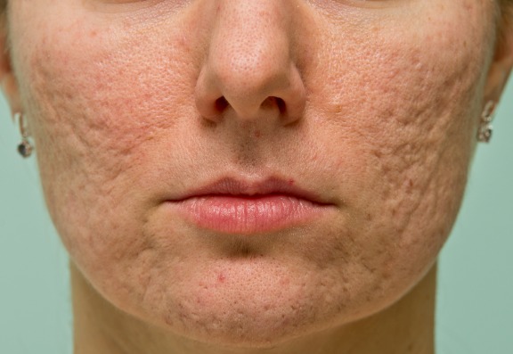 Acne-scarring targeted serums