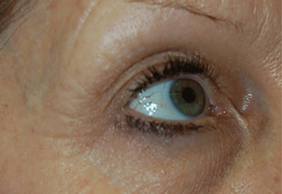 alternative to blepharoplasty