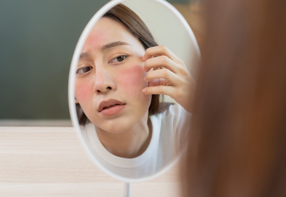 Living With Rosacea