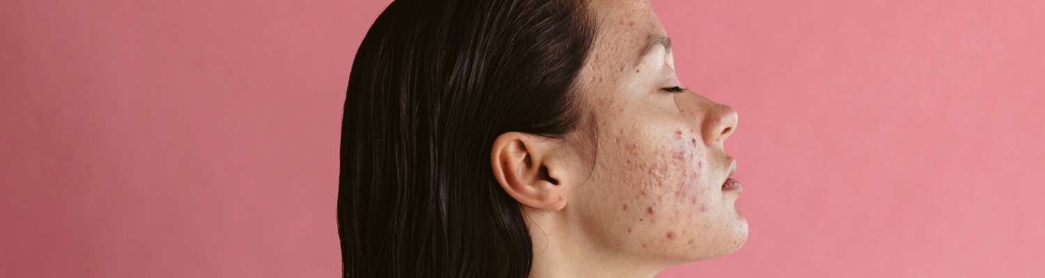 3 Ways to Treat Acne Scarring