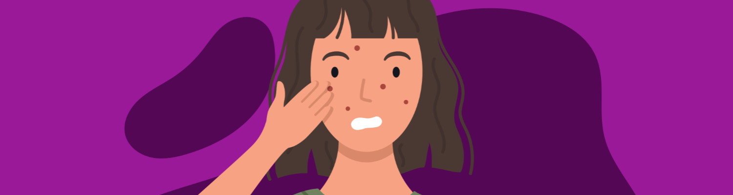 Acne Explained: Your No-Nonsense Guide to Everything Acne