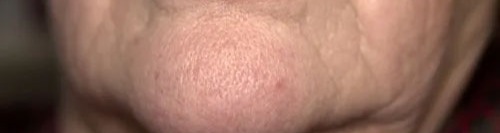 Botox for a Dimpled Chin... What You Need to Know