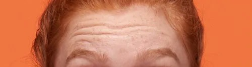 Botox for Forehead Lines