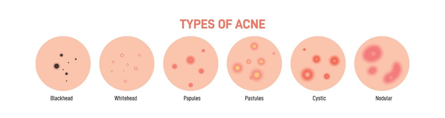 Bye Bye Acne! Is This Test the Answer to Getting Rid of Acne?