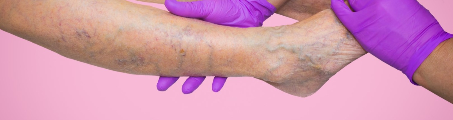 Changes to NHS Funding of Varicose Vein Procedures