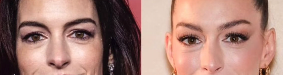 Did Anne Hathaway Really Have a Facelift? Experts Reveal the Subtle Signs You Might've Missed