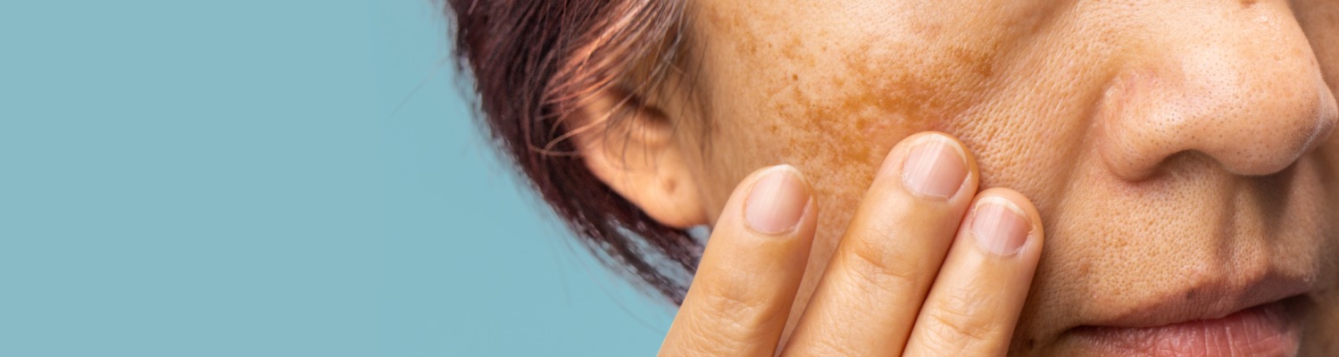 Do Away With Dark Spots: Treating Hyperpigmentation