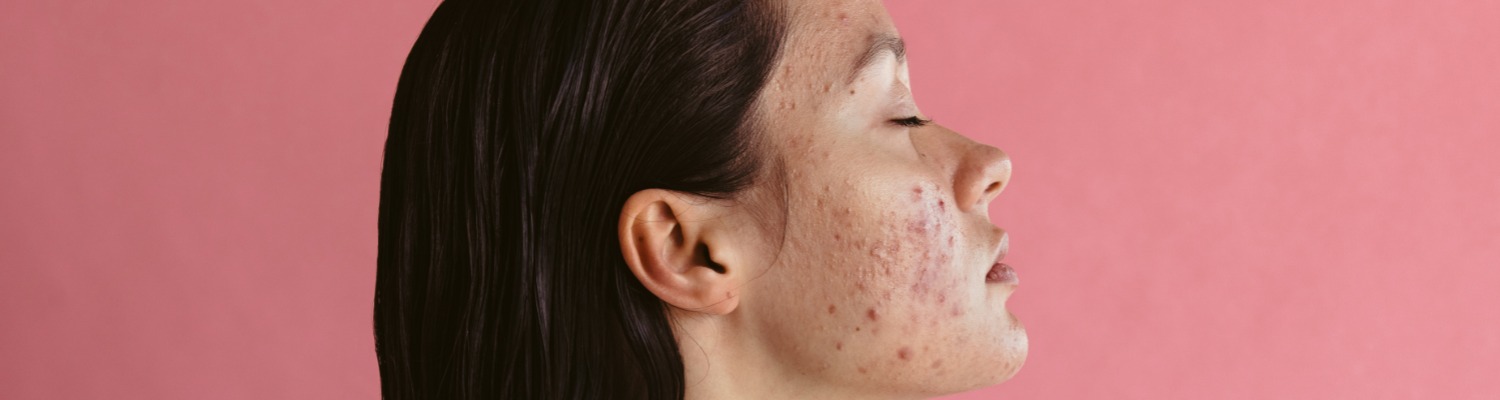 Do We Inherit Acne?
