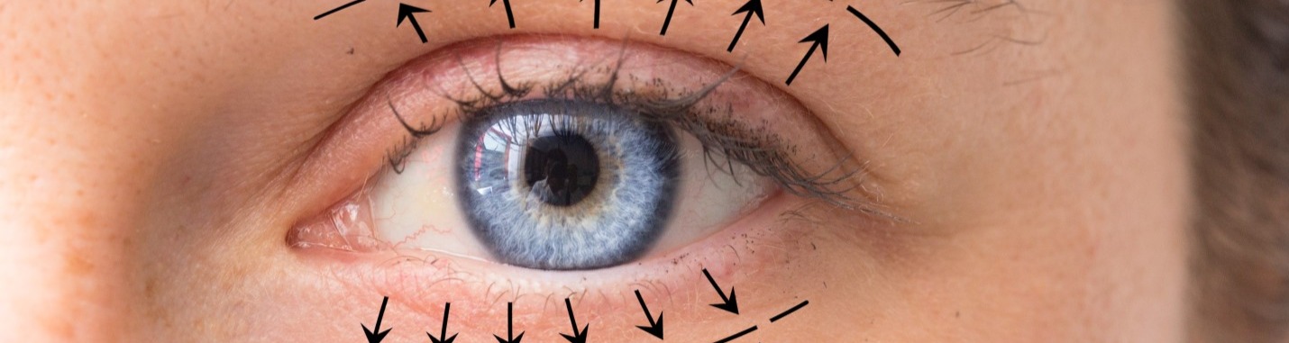 Eyelid Reduction Without Scars : Mini-Blepharoplasty