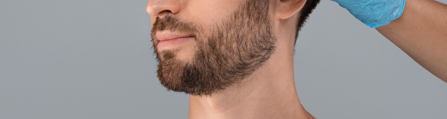 Facial Hair Transplants: The Latest Frontier for Men