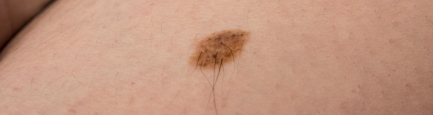 FAQ: Hairy Moles