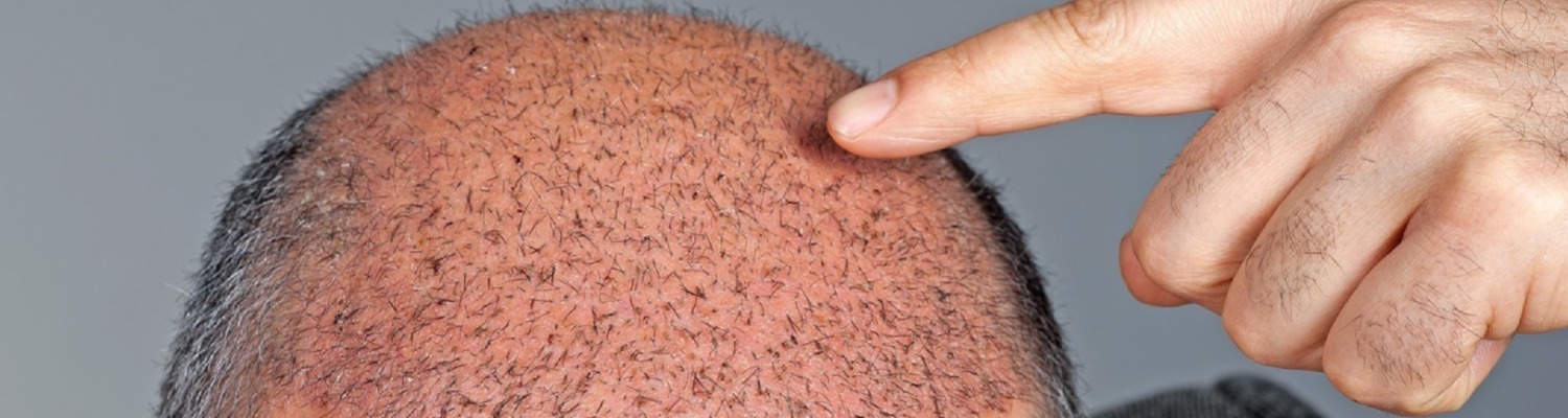 Hair Transplant Techniques Explained: FUE Versus FUT