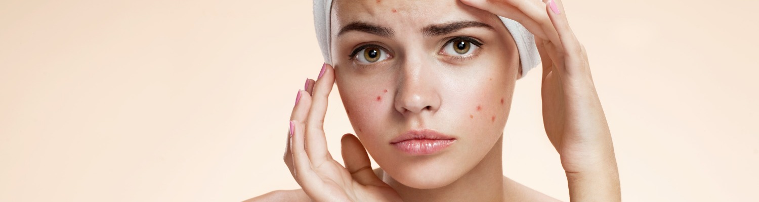 How to Keep Your Spots at Bay This Easter