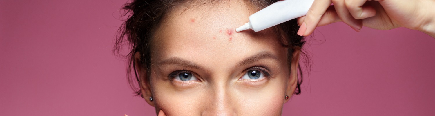 How to Manage Pregnancy Acne