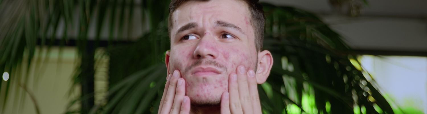 How to Shave When You Have Acne
