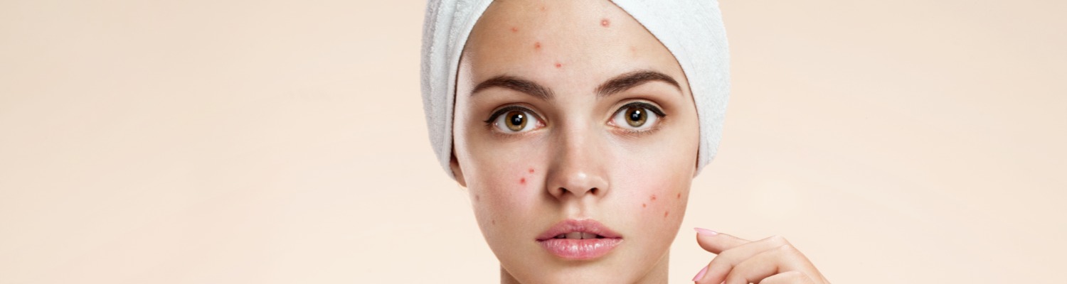Hydrafacial for Acne