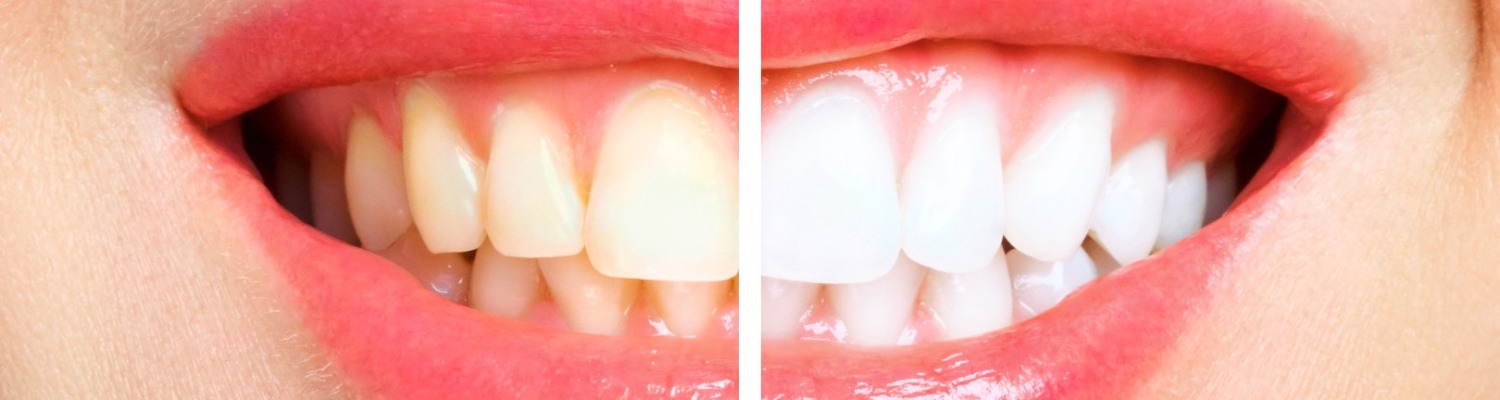 Illegal Tooth Whitening Crackdown by Government and Dentists