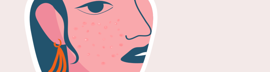 Is Acne Laser Treatment Effective for Teenage Skin?