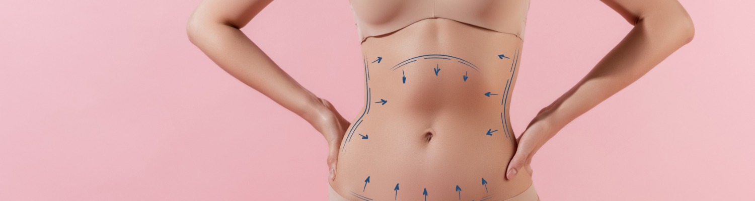 Lipoabdominoplasty My Way - The `Lock and Glue` Tummy Tuck