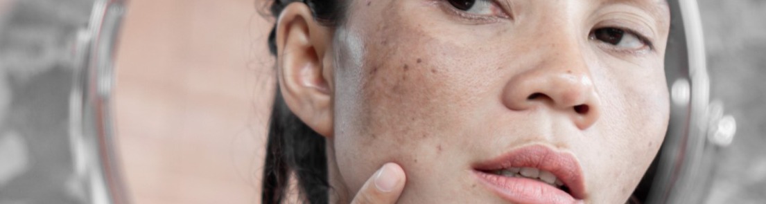 What Is Melasma?