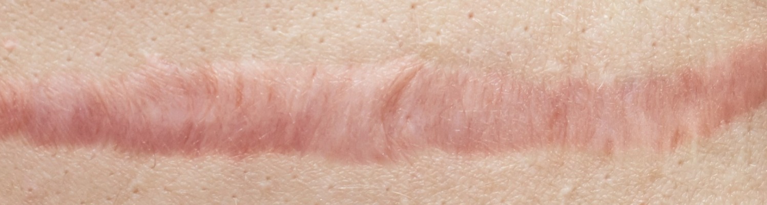 Male Scars