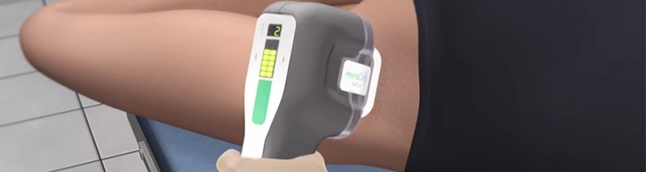 Miradry Is Life Changing for Hyperhidrosis Sufferers